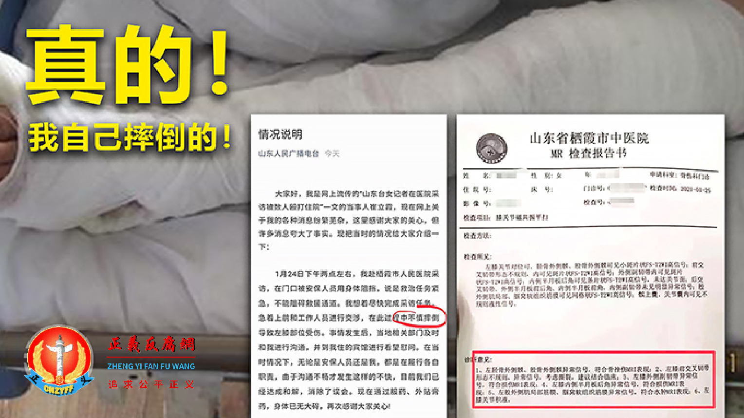 山东女记者受官方压舆论“翻脸声明”说是自己摔伤.png