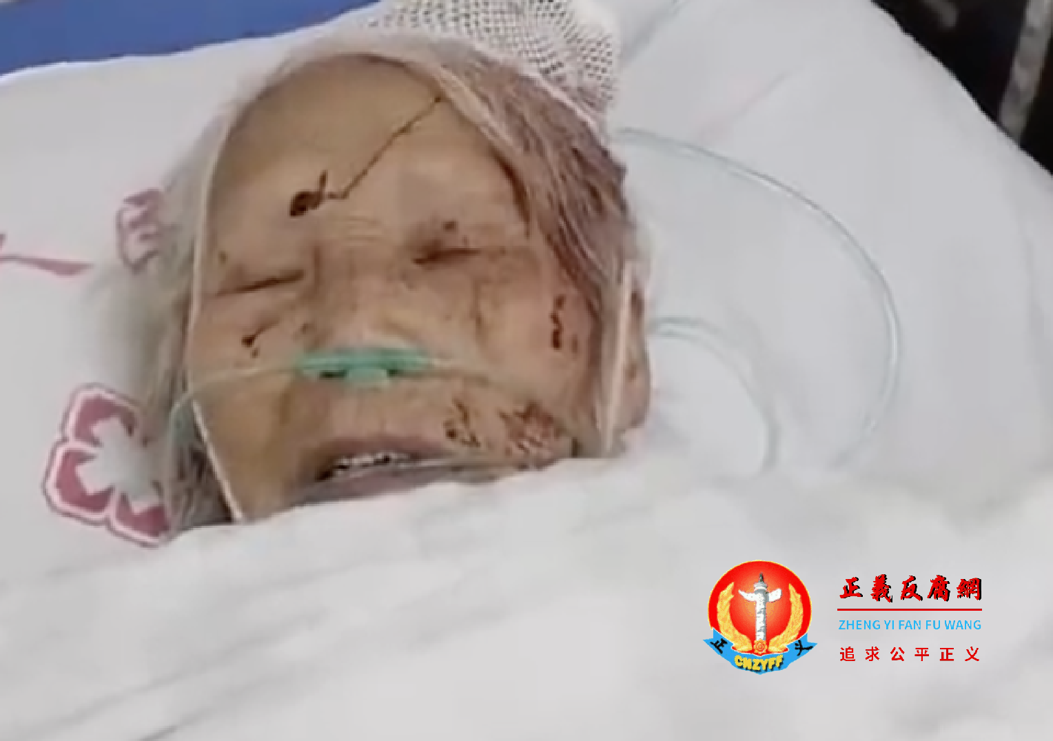 2023年1月21日,湖南省永州市一位83岁老人被儿子儿媳踢打,导致头部破裂住院。.png 2023年1月21日,湖南省永州市一位83岁老人被儿子儿媳踢打,导致头部破裂住院。.png