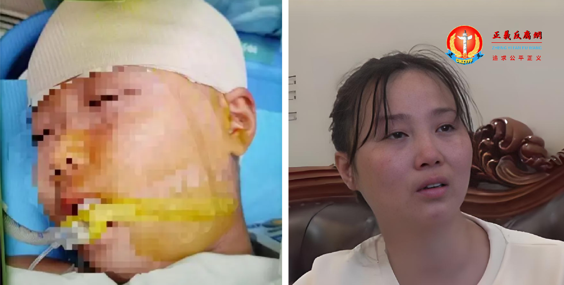 湖南省长沙市一名9岁女孩被老师用三角尺砸伤头骨,伤情构成重伤二级。此案经一审、二审,被告人最终被判刑五年。图为长沙被打伤的女孩(左)及其母亲。.png 湖南省长沙市一名9岁女孩被老师用三角尺砸伤头骨,伤情构成重伤二级。此案经一审、二审,被告人最终被判刑五年。图为长沙被打伤的女孩(左)及其母亲。.png