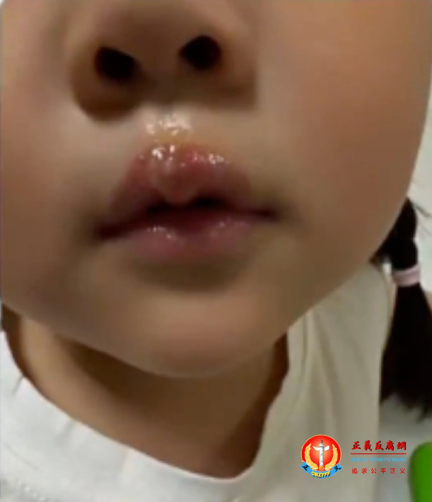 江苏徐州丰县机关第二幼儿园女幼童被曝遭教师用热熔胶烫嘴